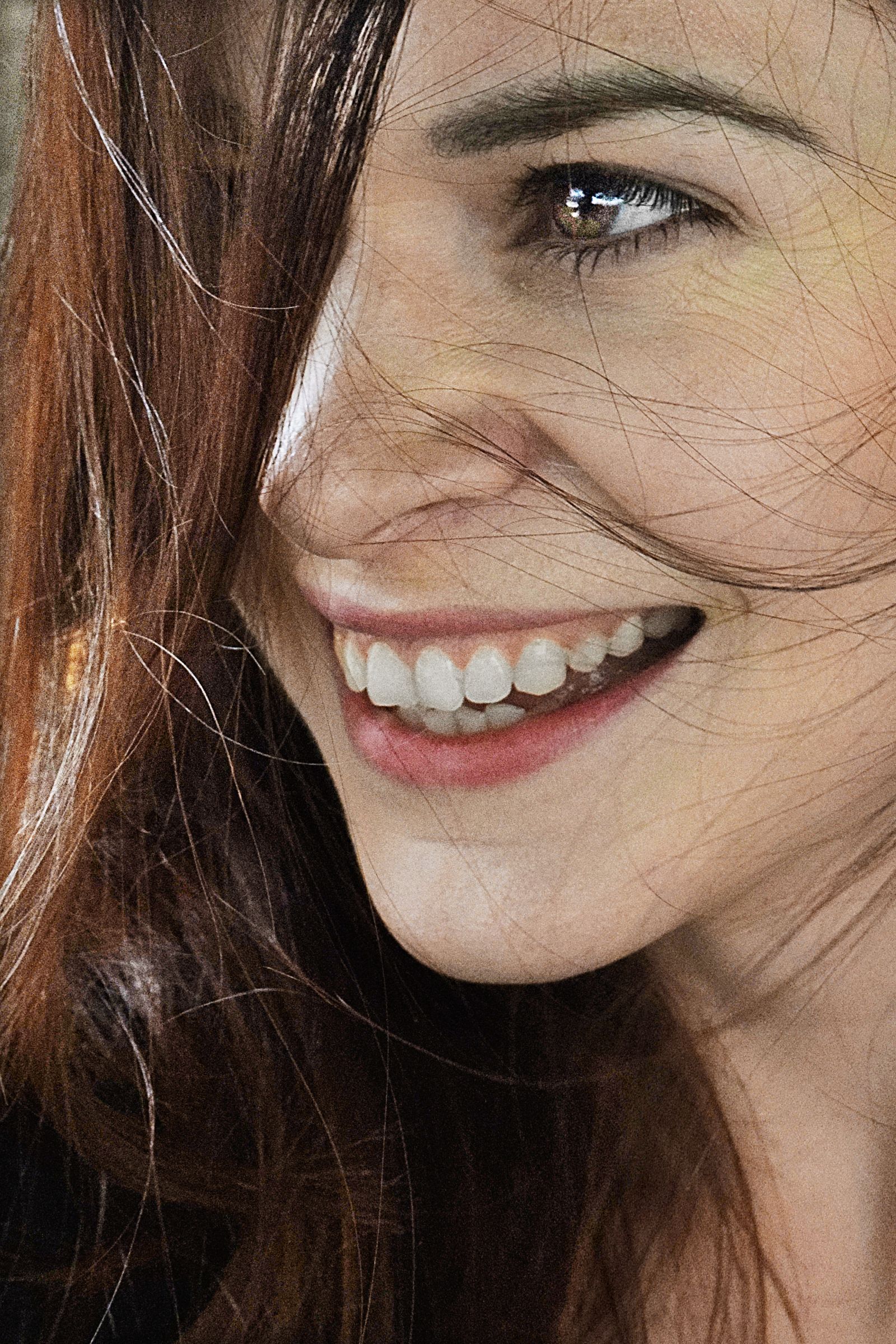 Patient smile after clear aligners, 11 months (sample image)